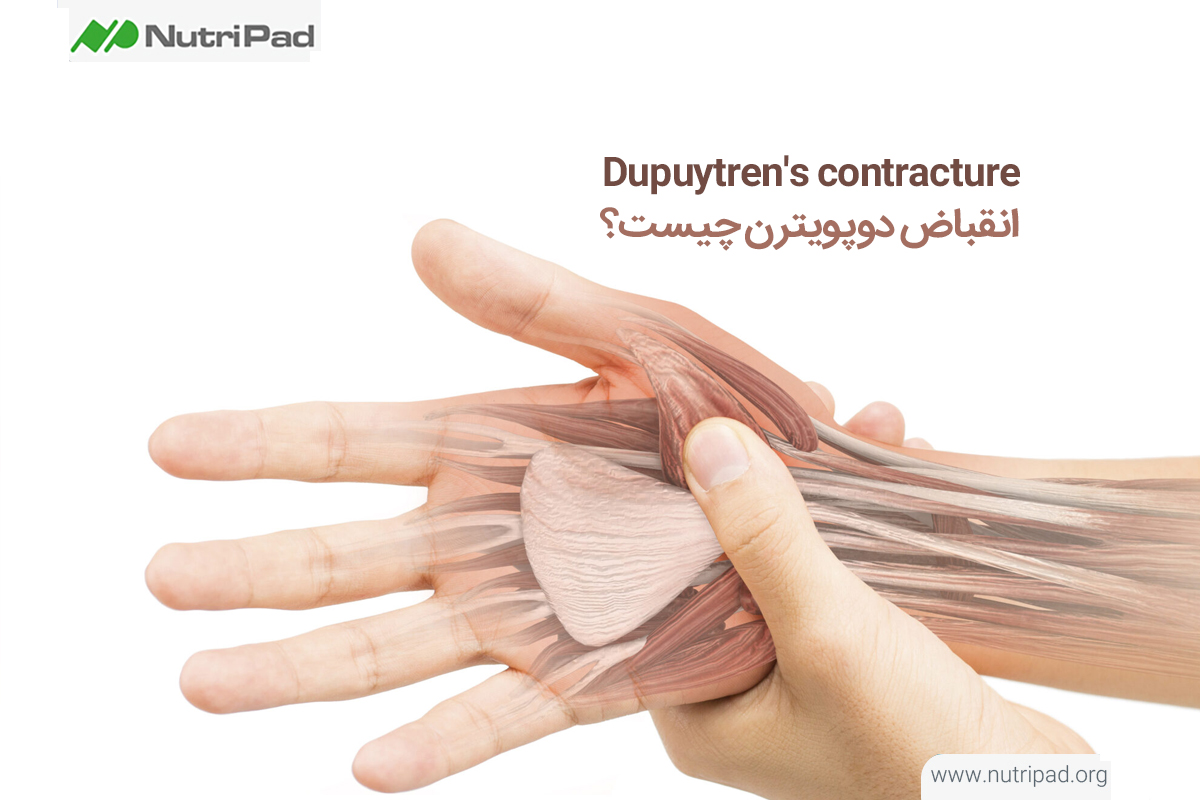 انقباض دوپویترن (Dupuytren's contracture) چیست؟