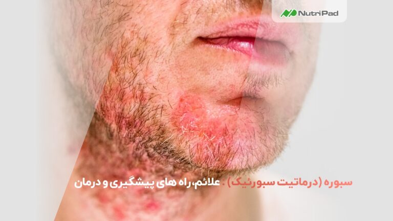 سبوره (درماتیت سبورئیک) : علائم، راه های پیشگیری و درمان - نوتر ی پاد