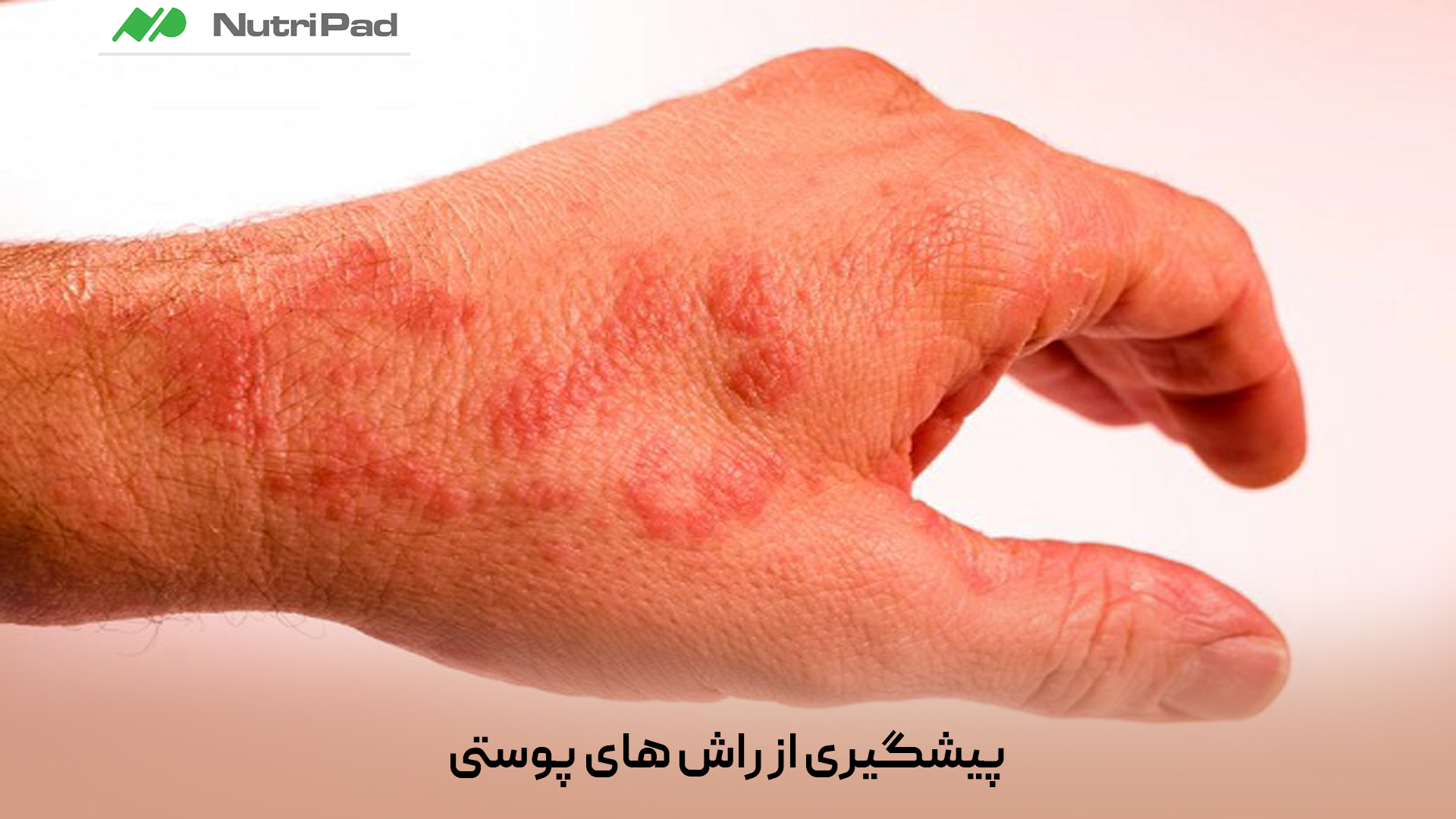 چگونه می‌توان از بروز راش‌های پوستی پیشگیری کرد؟