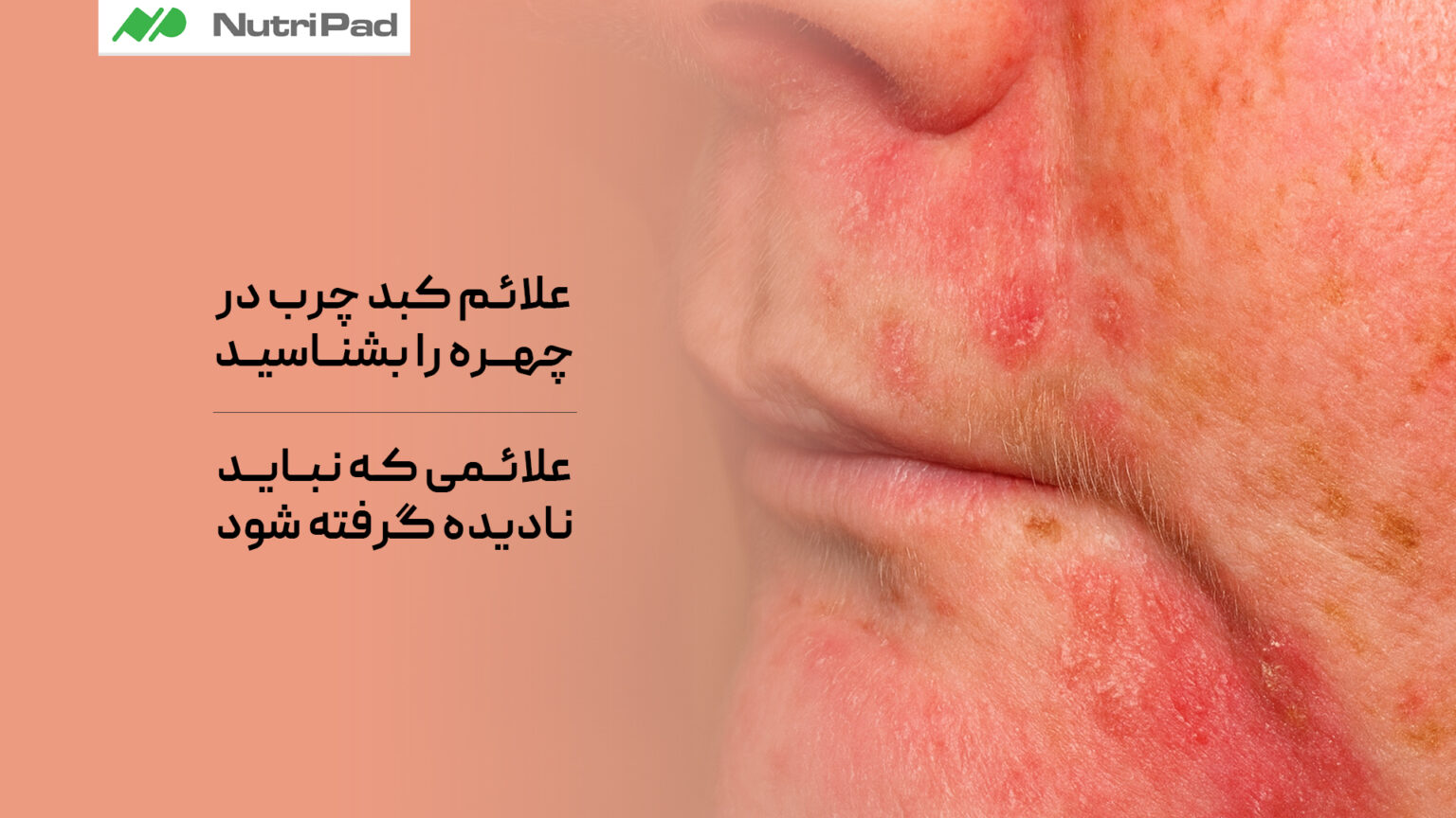 علائم کبد چرب در چهره چیست؟