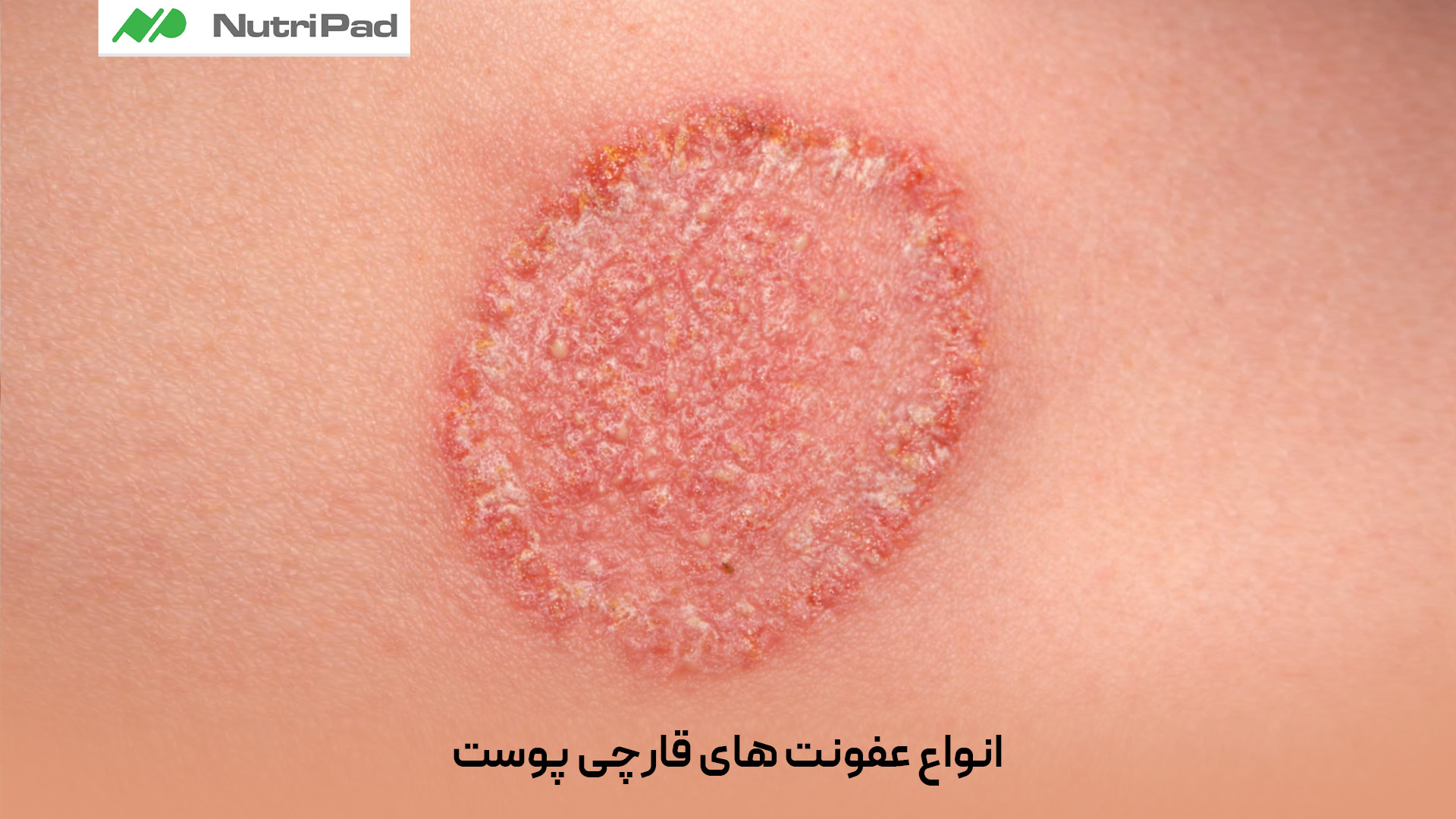 عفونت های قارچی پوست انواع مختلفی دارند که شایع ترین آنها عبارتاند از: تینهآ یا درماتوفیتوز (مانند قارچ پا، قارچ کشاله ران و قارچ بدن)، کاندیدیاز پوستی که بیشتر در نواحی مرطوب چیندار بدن دیده میشود، پیتریازیس ورسیکالر که باعث ایجاد لکه های روشن یا تیره روی پوست میشود، و عفونت قارچی پوست سر که میتواند با ریزش مو همراه باشد. انواع عفونت های قارچی پوست