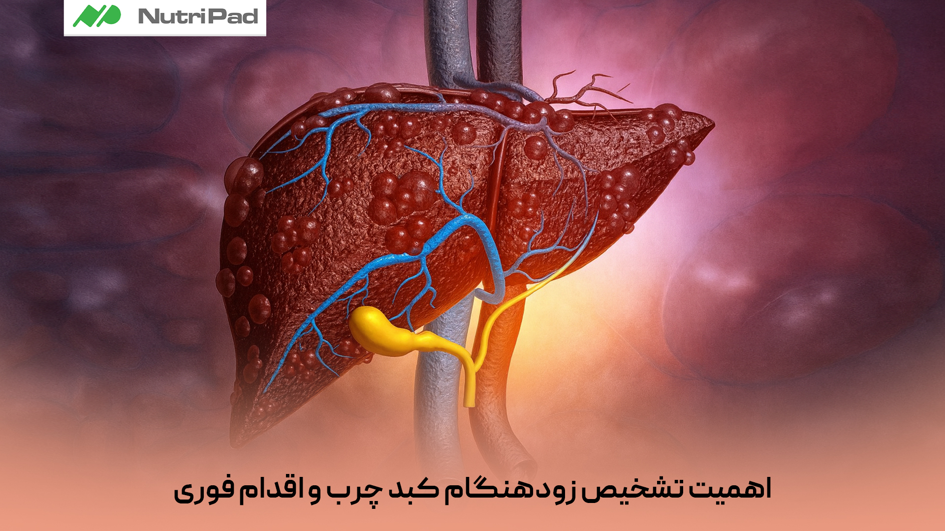 چرا تشخیص زودهنگام کبد چرب و اقدام فوری اهمیت دارد؟
