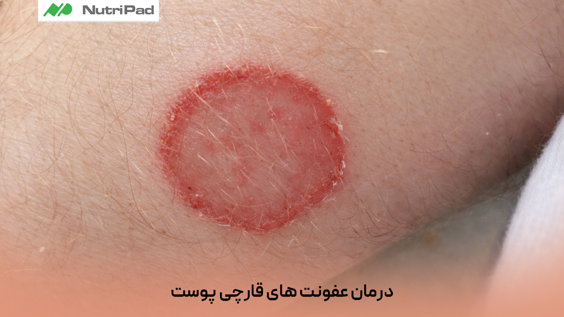 درمان عفونت های قارچی پوست معمولاً با استفاده از داروهای ضدقارچ موضعی مانند کرم، پماد یا لوسیون انجام میشود. در موارد شدید یا مقاوم، پزشک ممکن است داروهای خوراکی ضدقارچ تجویز کند. خشک نگه داشتن پوست، رعایت بهداشت فردی، تعویض منظم لباس های مرطوب و پرهیز از خوددرمانی نقش مهمی در بهبود و پیشگیری از عود عفونت دارند. آیا عفونت قارچی پوست درمان میشود؟