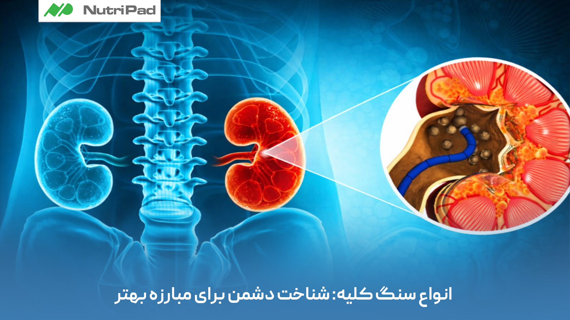 سنگ های کلیه انواع مختلفی دارند که هرکدام علت تشکیل، ویژگیها و راهکار درمانی خاص خود را دارند. شایعترین نوع، سنگهای کلسیمی (بهویژه کلسیم اگزالات) هستند که معمولاً بهدلیل کمنوشیدن آب، رژیم غذایی نامناسب یا اختلالات متابولیک ایجاد میشوند. سنگهای اسید اوریکی بیشتر در افرادی دیده میشوند که مصرف بالای پروتئین حیوانی دارند یا به نقرس مبتلا هستند. سنگهای استروویتی اغلب در اثر عفونتهای مکرر ادراری شکل میگیرند و میتوانند بهسرعت بزرگ شوند. نوع نادرتر، سنگهای سیستئینی است که منشأ ژنتیکی دارد. شناخت نوع سنگ کلیه به پزشک کمک میکند تا مؤثرترین روش درمان و بهترین راهکارهای پیشگیری، از جمله اصلاح تغذیه و سبک زندگی، را برای بیمار انتخاب کند. انواع سنگ کلیه کداماند و چرا شناخت آنها برای درمان و پیشگیری اهمیت دارد؟
