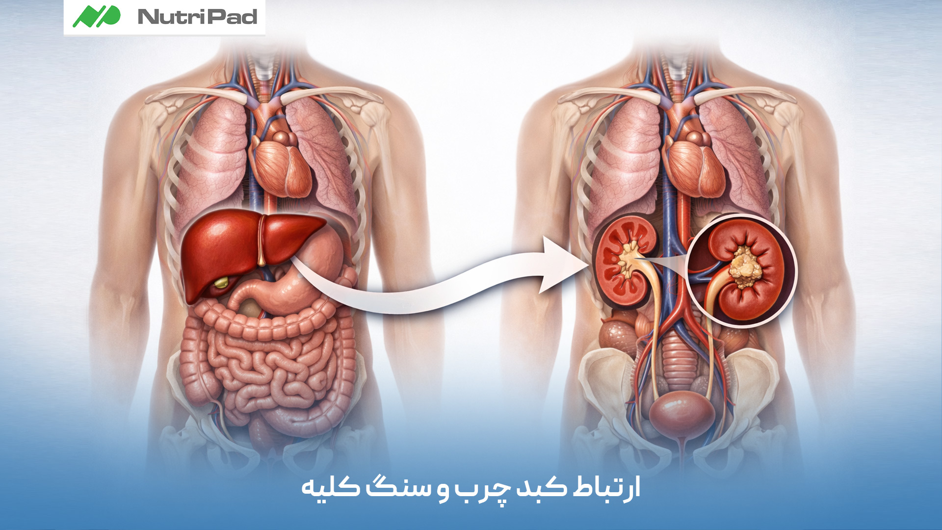 استرس مزمن و فشارهای عصبی میتوانند به طور غیرمستقیم سلامت کلیه ها را تحت تأثیر قرار دهند. فعال شدن طولانیمدت سیستم عصبی سمپاتیک باعث افزایش فشار خون، تغییر در جریان خون کلیوی و برهم خوردن تعادل هورمونها میشود که همگی از عوامل خطر آسیب کلیه هستند. علاوه بر این، استرس میتواند عادتهای ناسالمی مانند کمنوشیدن آب، تغذیه نامناسب و اختلال خواب را تشدید کند که به مرور زمان عملکرد کلیهها را تضعیف میکنند. بنابراین مدیریت استرس و حفظ آرامش روانی، در کنار درمانهای پزشکی، نقش مهمی در پیشگیری و کنترل بیماریهای کلیوی دارد. نقش اعصاب و استرس در بروز یا تشدید بیماری های کلیوی چیست؟