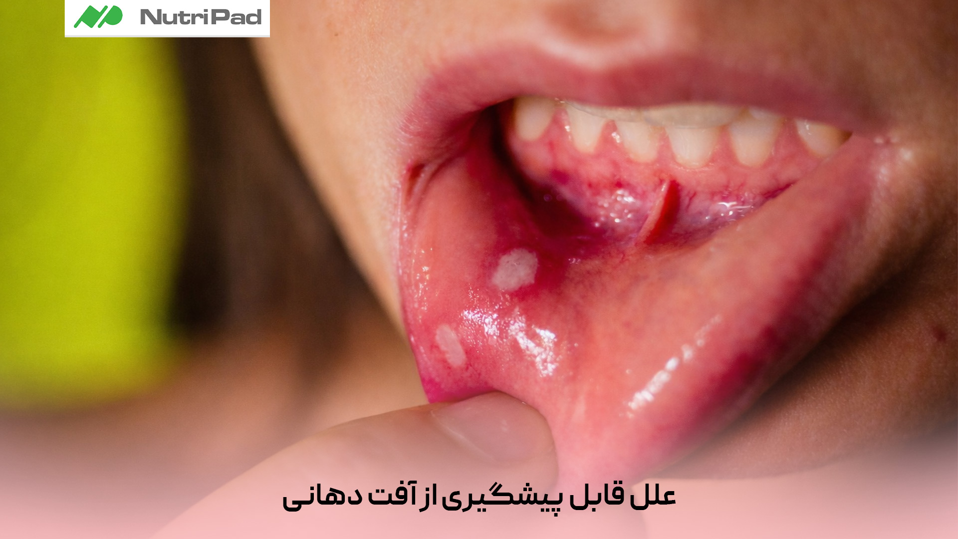 بخش زیادی از آفت های دهانی ناشی از عواملی هستند که با اصلاح سبک زندگی و مراقبت های ساده قابل پیشگیریاند. شایعترین علل قابل پیشگیری شامل آسیبهای مکانیکی (گاز گرفتن گونه، مسواک زبر، لبه تیز دندان یا پروتز نامناسب)، استرس و اضطراب مزمن، کمبودهای تغذیهای مانند آهن، ویتامین B12 و اسیدفولیک، رعایت نکردن بهداشت دهان و دندان، مصرف غذاهای محرک مثل غذاهای بسیار تند، اسیدی یا شور، سیگار و الکل و استفاده از خمیردندانهای حاوی سدیم لوریل سولفات (SLS) است. با کاهش استرس، تغذیه متعادل، استفاده از مسواک نرم و خمیردندان مناسب، پرهیز از خوراکیهای محرک و حفظ بهداشت دهان میتوان تا حد زیادی از بروز آفت دهانی جلوگیری کرد. علل قابل پیشگیری آفت دهانی کداماند و چگونه میتوان از بروز آنها جلوگیری کرد؟