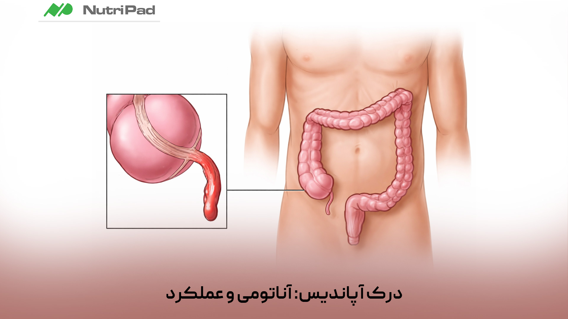 آپاندیس یک زائدهی باریک و لولهایشکل به طول حدود ۸ تا ۱۰ سانتیمتر است که به ابتدای روده بزرگ (سکوم) در ربع تحتانی راست شکم متصل میشود. این عضو حاوی بافت لنفاوی فراوان است و برخلاف تصور قدیمی که آن را بیاستفاده میدانستند، امروزه نقشهایی برای آن در نظر گرفته میشود. آپاندیس بهویژه در تقویت سیستم ایمنی، کمک به شناسایی عوامل بیماریزا و حفظ باکتریهای مفید روده نقش دارد و میتواند به بازسازی فلور طبیعی روده پس از عفونتها کمک کند. با این حال، برداشتن آپاندیس در صورت التهاب معمولاً تأثیر منفی قابلتوجهی بر سلامت کلی فرد ندارد. آپاندیس چیست، کجای بدن قرار دارد و چه عملکردی دارد؟