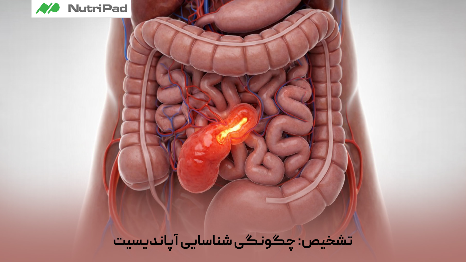 تشخیص آپاندیسیت معمولاً با بررسی علائم بالینی و معاینه فیزیکی آغاز میشود. درد شکم که اغلب از اطراف ناف شروع شده و به تدریج به ربع تحتانی راست شکم منتقل میشود، یکی از مهمترین نشانههاست. پزشک با معاینه، حساسیت و درد فشاری این ناحیه را ارزیابی میکند. در کنار آن، آزمایش خون برای بررسی افزایش گلبولهای سفید و علائم التهاب انجام میشود. روشهای تصویربرداری مانند سونوگرافی (بهویژه در کودکان و زنان باردار) و سیتیاسکن برای تأیید تشخیص آپاندیس و بیماری های مشابه به کار میروند. ترکیب این یافته ها به پزشک کمک میکند آپاندیسیت را به موقع و با دقت تشخیص دهد. آپاندیسیت چگونه تشخیص داده میشود و چه روش هایی برای شناسایی آن وجود دارد؟